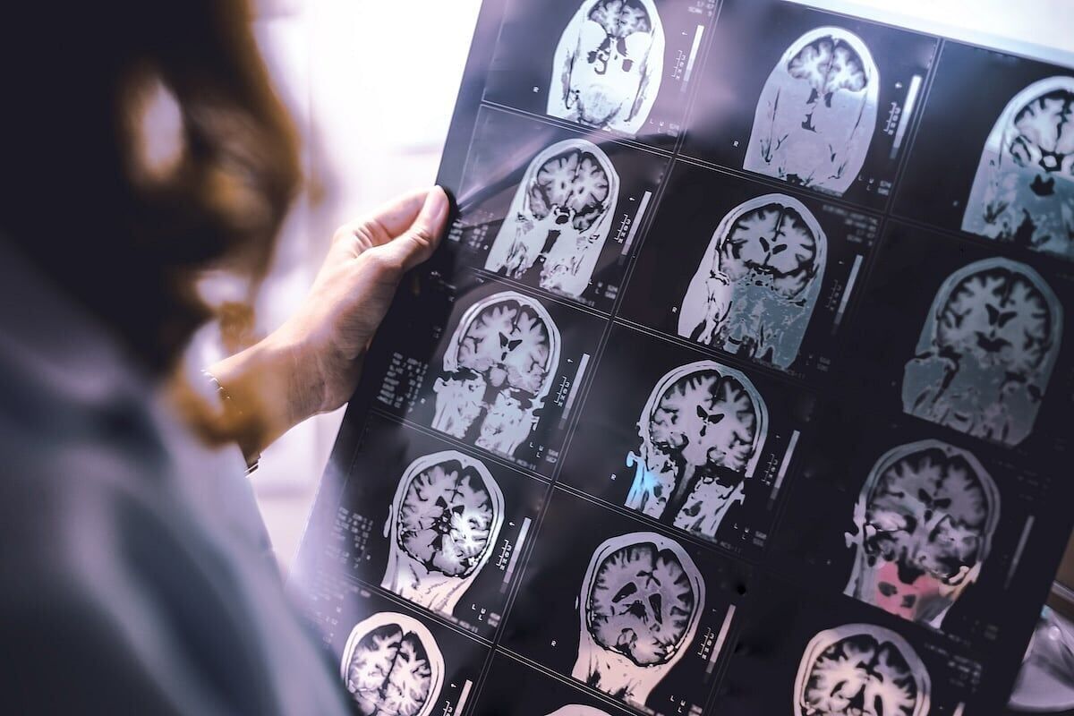 Diabetes Drugs Might Counter Brain Decline In Early Alzheimer's Patients